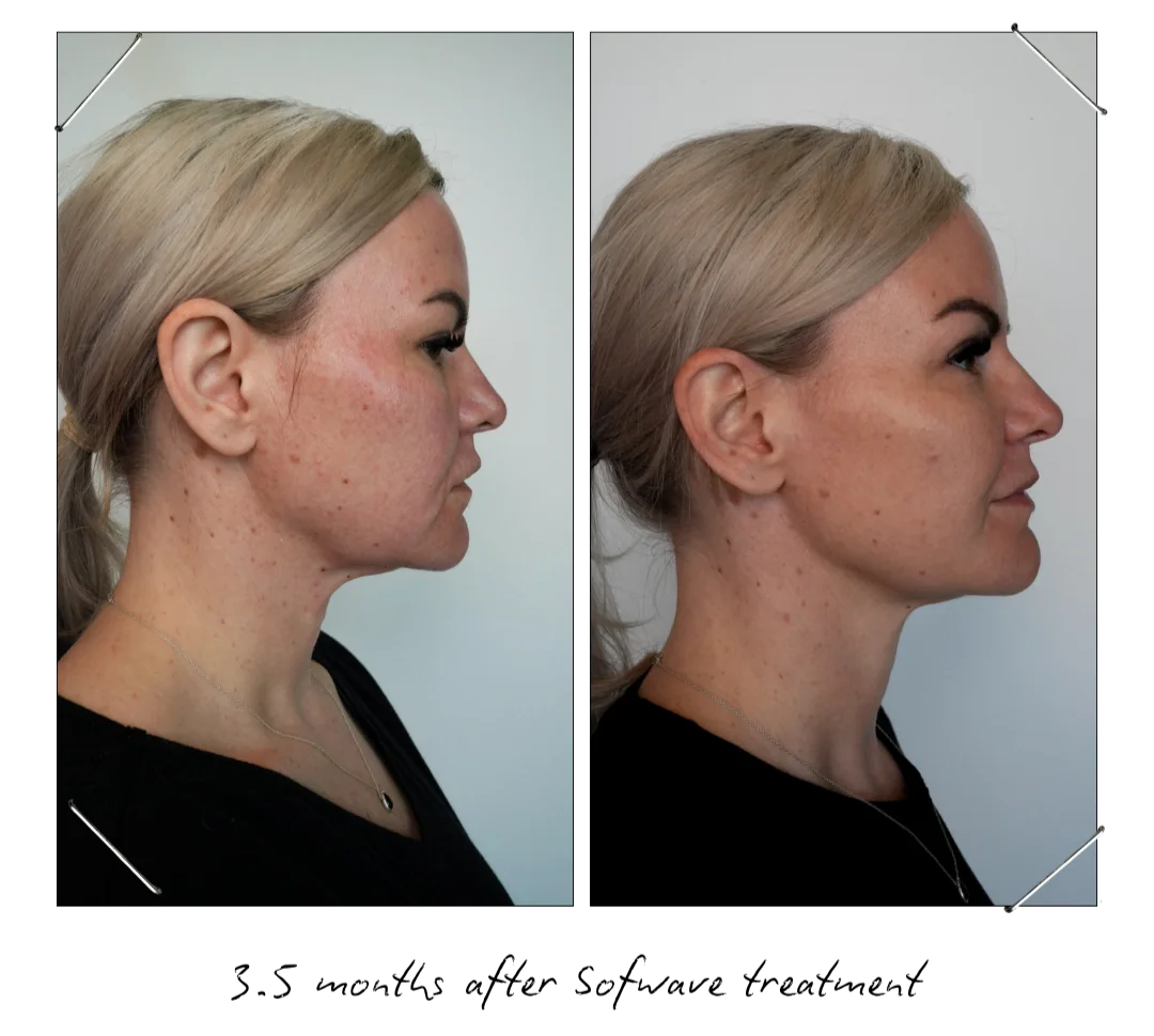 Tighten Jowls and Lower Face With Sofwave