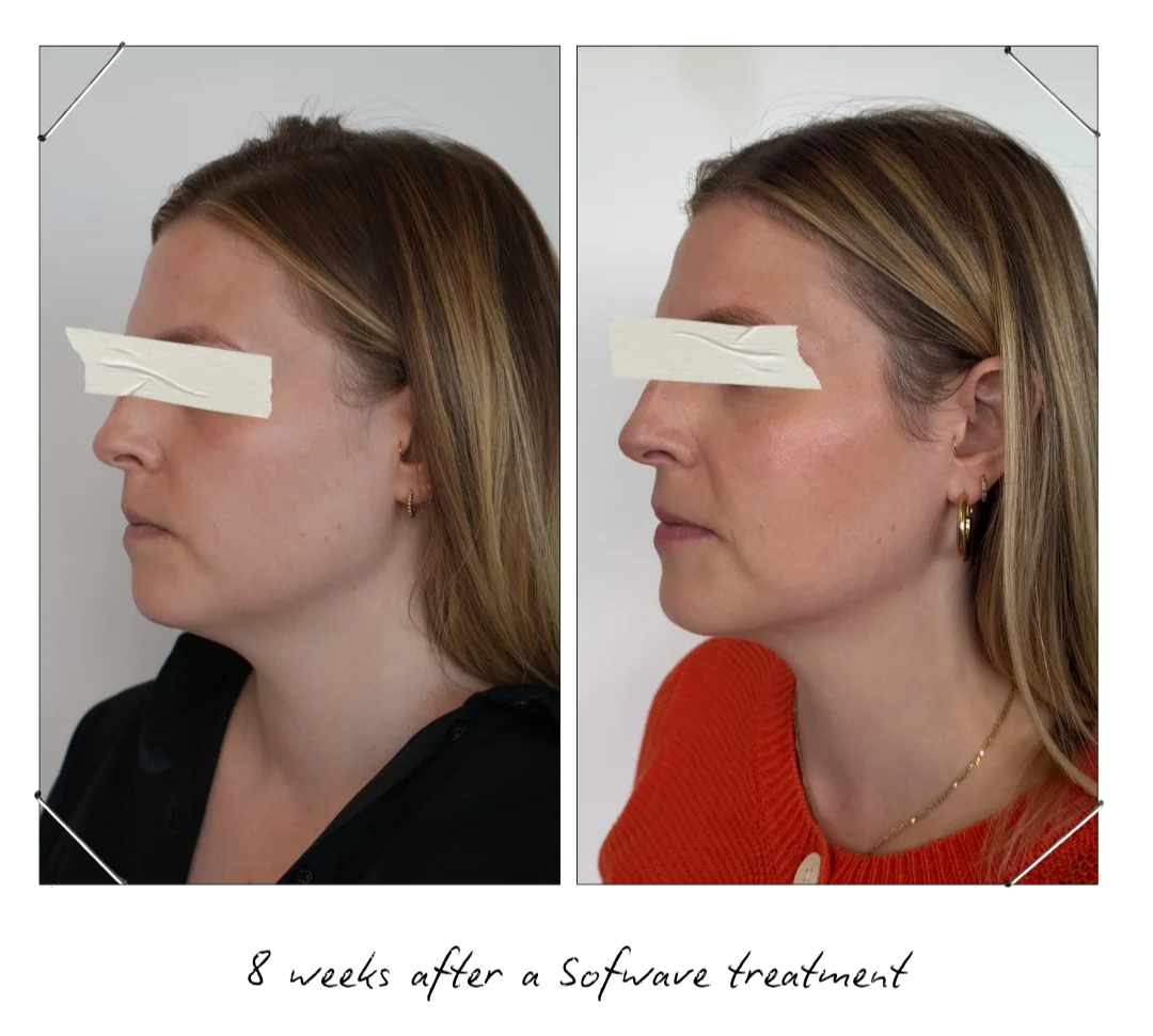 One Sofwave session - tighter skin, sharper jawline