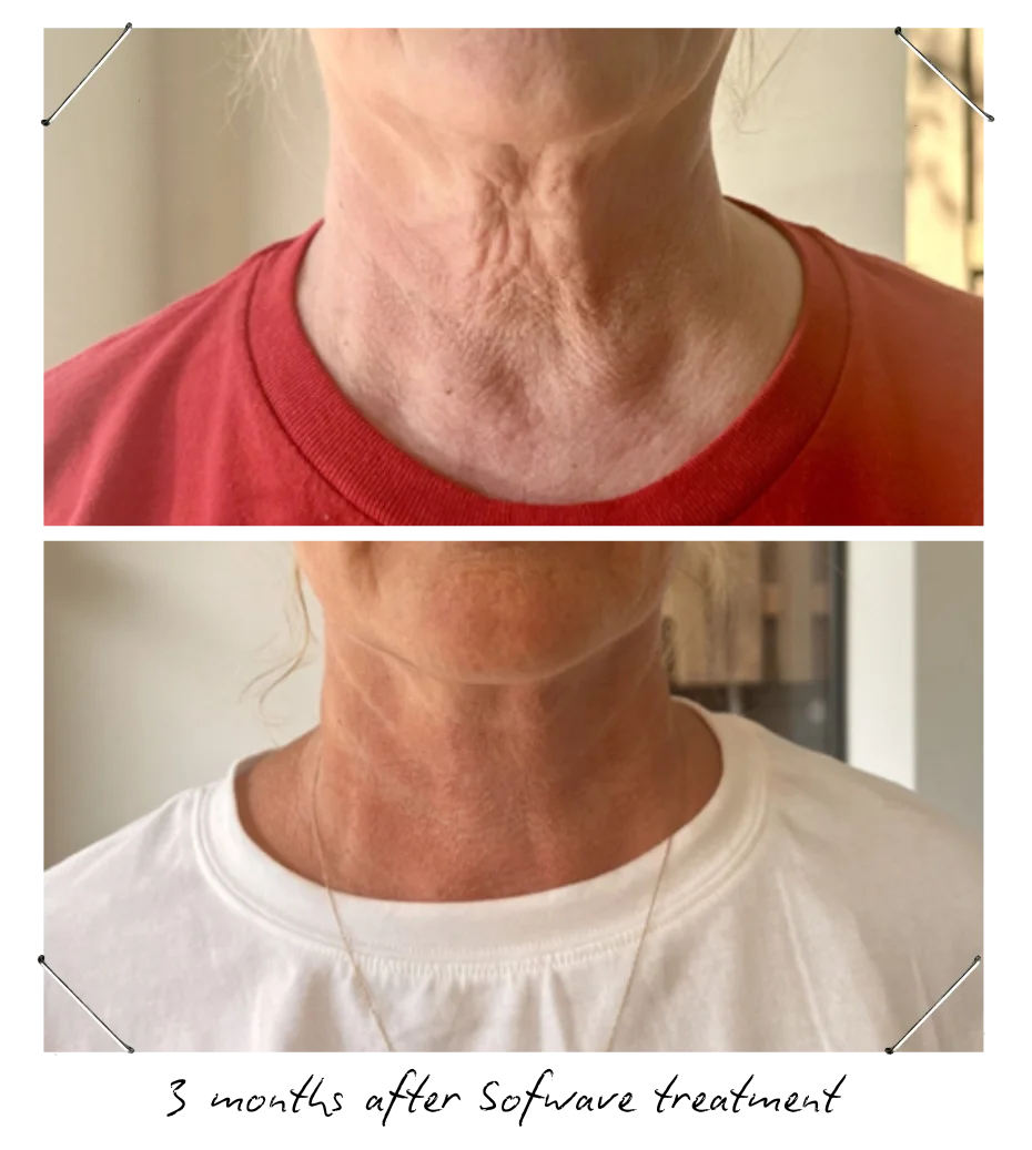 Sofwave for neck tightening and jowls