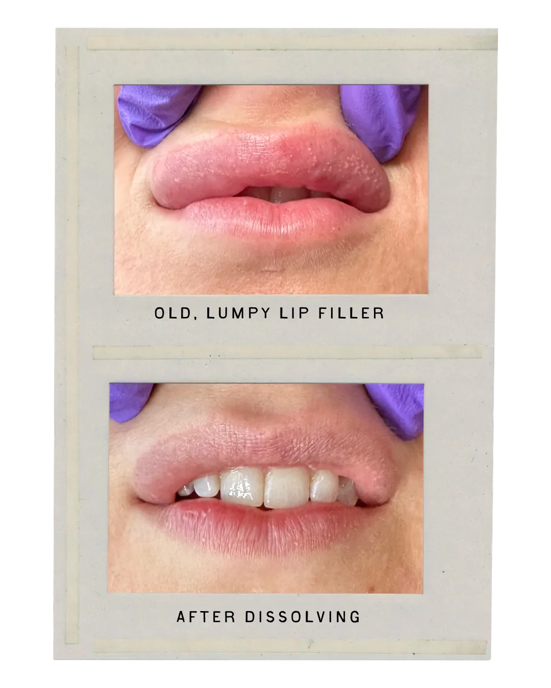 Filler Dissolving treatment at Maintenance Bar