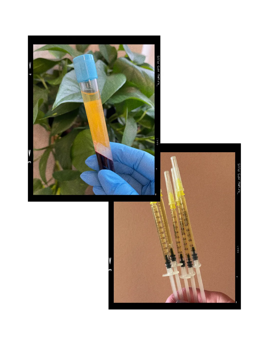 PRP for Under Eyes candidate